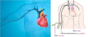 PICC 并发深静脉血栓是拔是留？这 4 个问题需关注