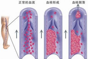 静脉血栓栓塞症的预防