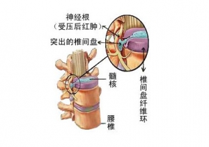 老年骨质疏松性胸腰椎压缩骨折治疗的护理