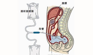 腹膜透析，如何保护好透析导管?