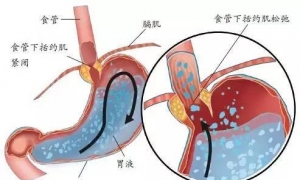 临床证据总结：胃食管反流与体位相关性