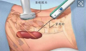 肾穿刺活检术的护理——西京医院肾内科