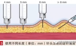 权威：2016版糖尿病注射技术现状及指南解读