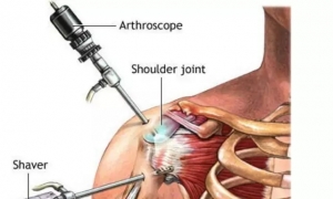 肩关节术后康复指南——图文解说，一看就会！