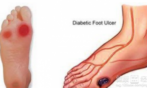 2016美国糖尿病足伤口护理指南