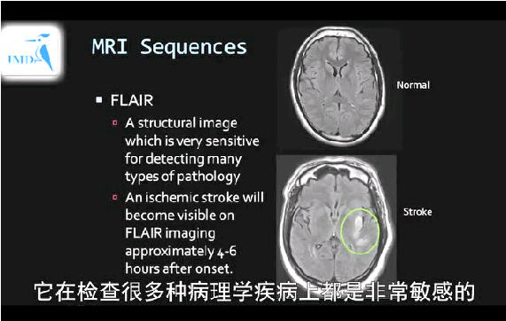 卒中诊断 ——美国霍普金斯大学