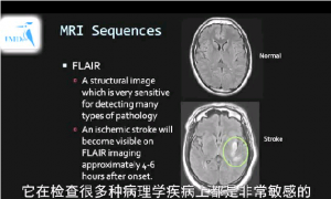 卒中诊断 ——美国霍普金斯大学