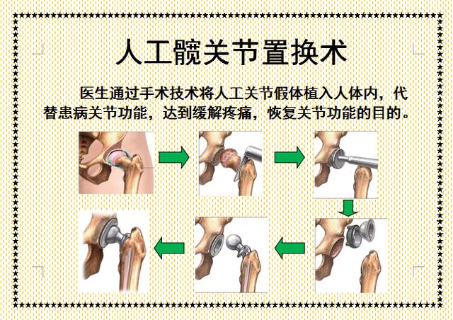 人工髋关节置换术后体位指导画册，三甲医院护士教您如何护理！