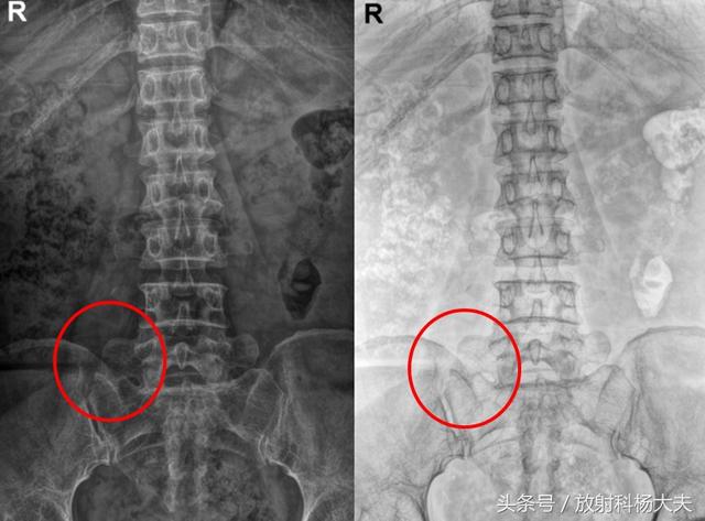 急诊科护士腰痛，拍了片子，发现第5腰椎与其他人不同