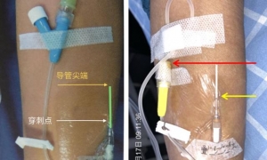 有错必纠丨留置针固定4个要点，最后一个有问题