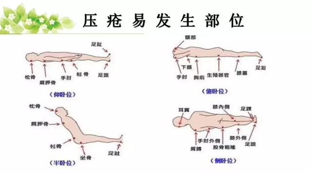 面对压疮不要慌，护理小妙招帮你忙！