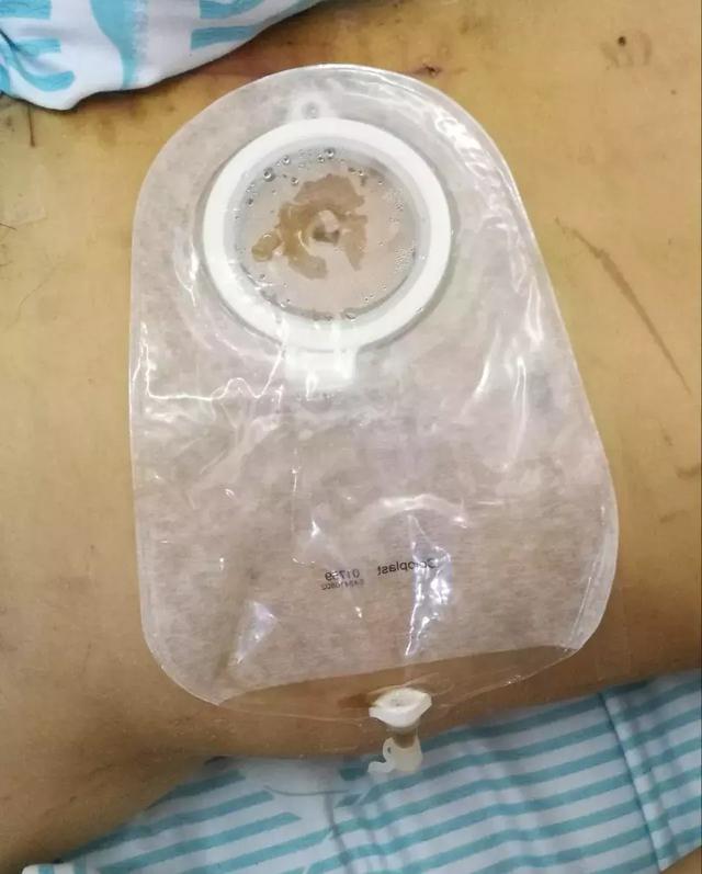 大腿打石膏咋穿内裤？引流液外渗怎么办？临床小窍门解决大问题！