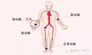 手把手教会护士，正确的动脉采血（部位、方法）