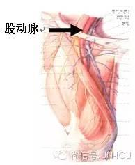 手把手教会护士，正确的动脉采血（部位、方法）