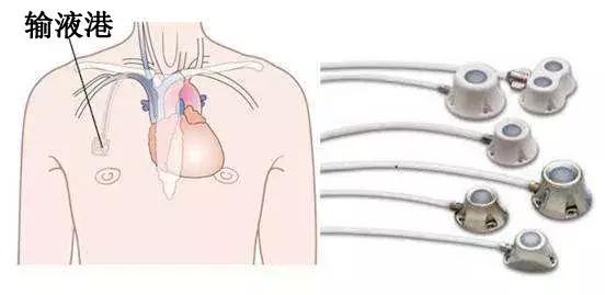 手臂输液港与胸壁输液港“安全大PK”