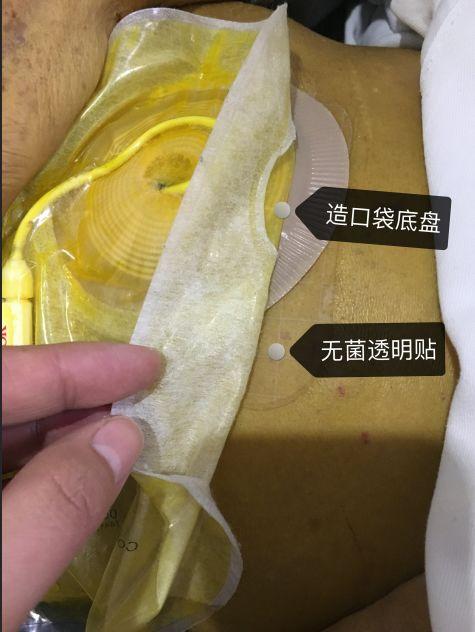 造口袋接引流渗液违反无菌？试试这个方法~