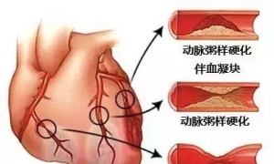 史上最全的心血管疾病图文详解记得收藏