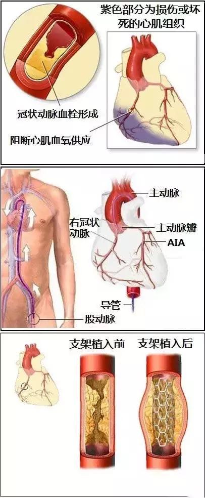 史上最全的心血管疾病图文详解 记得收藏