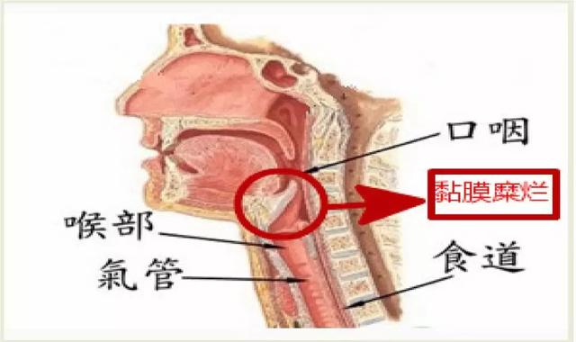 胃管插不进去？机智护士“打通隧道”巧解决！