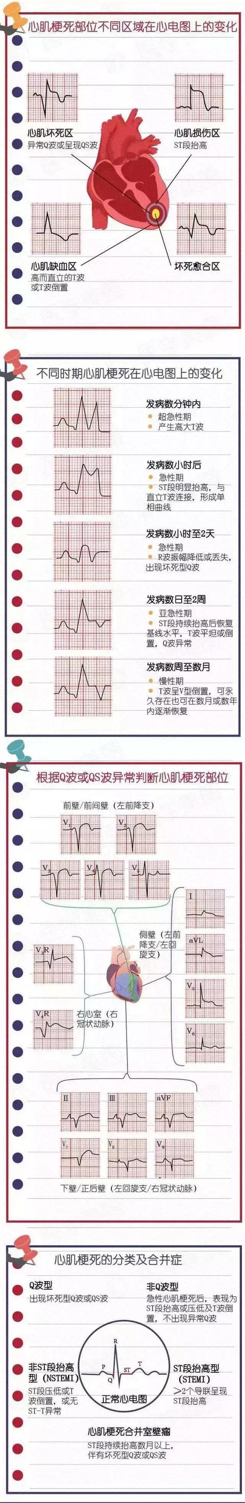 心肌梗死心电图