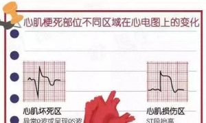 心肌梗死心电图