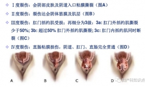 【产科危重症】之“产后出血”（第一部分）——病因篇（附：出血量估计） ... ...