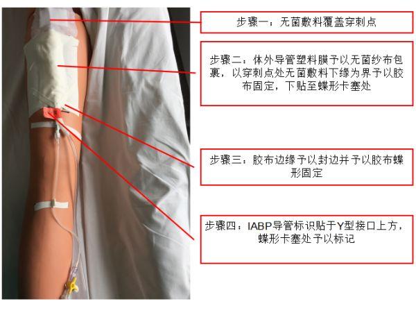 IABP导管易脱出、胶布过敏？这两种固定方法对症下药