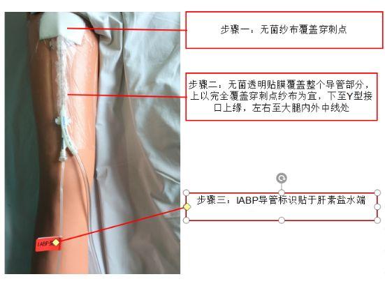 IABP导管易脱出、胶布过敏？这两种固定方法对症下药