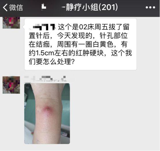 留置针拔除后针眼感染化脓，罪魁祸首竟然是这个！