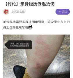 热水袋烧伤案例终身难忘，这种处理方法赶紧收藏~