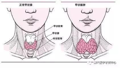 关于甲状腺结节的七个问题！