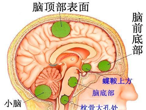 神经外科后颅窝颅底手术的护理配合