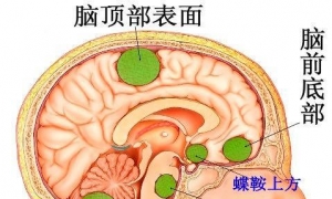 神经外科后颅窝颅底手术的护理配合